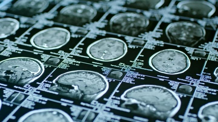 MUCRAN el modelo de IA que identifica el Alzheimer